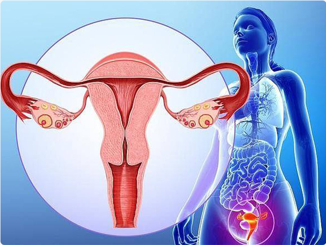 卵巢癌——沉默的“妇科杀手”